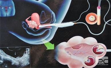 体外受精 IVF-ET
